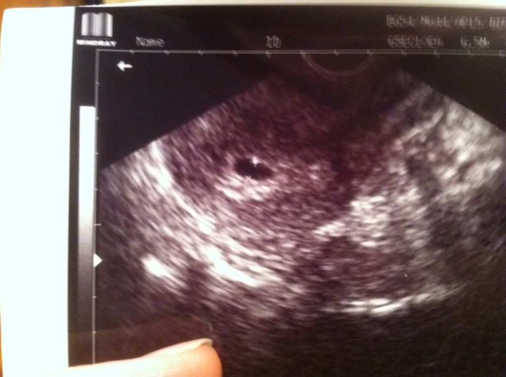 5 week Ultrasound...two yolk sacs?? BabyGaga